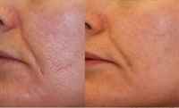 laser-genesis-skin-therapy-virginia-beach-laser-treatment-300x182