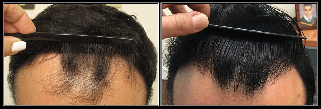 Board Certified Hair Restoration