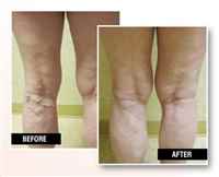 Before-And-After-Vein-Treatment-2