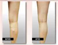 Before-And-After-Vein-Treatment-1