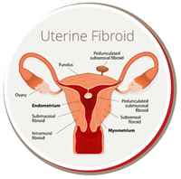 uterine-fibroid-bing