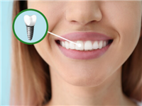 dental implants York