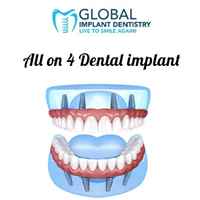 All-on-4 Dental Implant